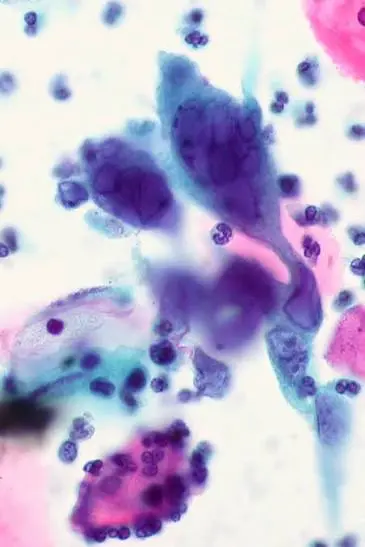 تبخال تناسلی