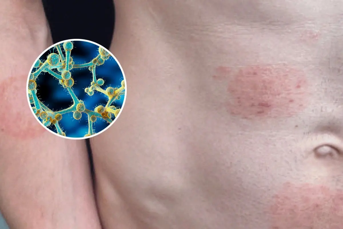 fungal-infection-nyc