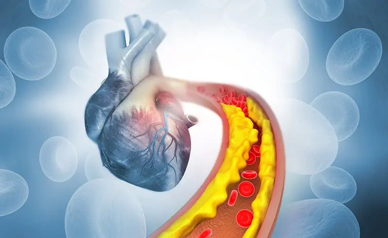 01-atherosclerosis