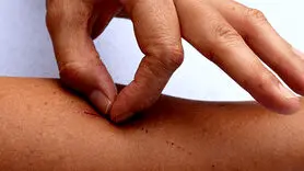 آیا کندن پوست نشان دهنده اضطراب است؟ 
