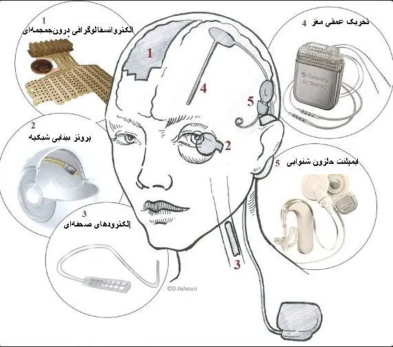 آشنایی با ایمپلنت‌های مغزی یا وسایل کاشتنی مغزی