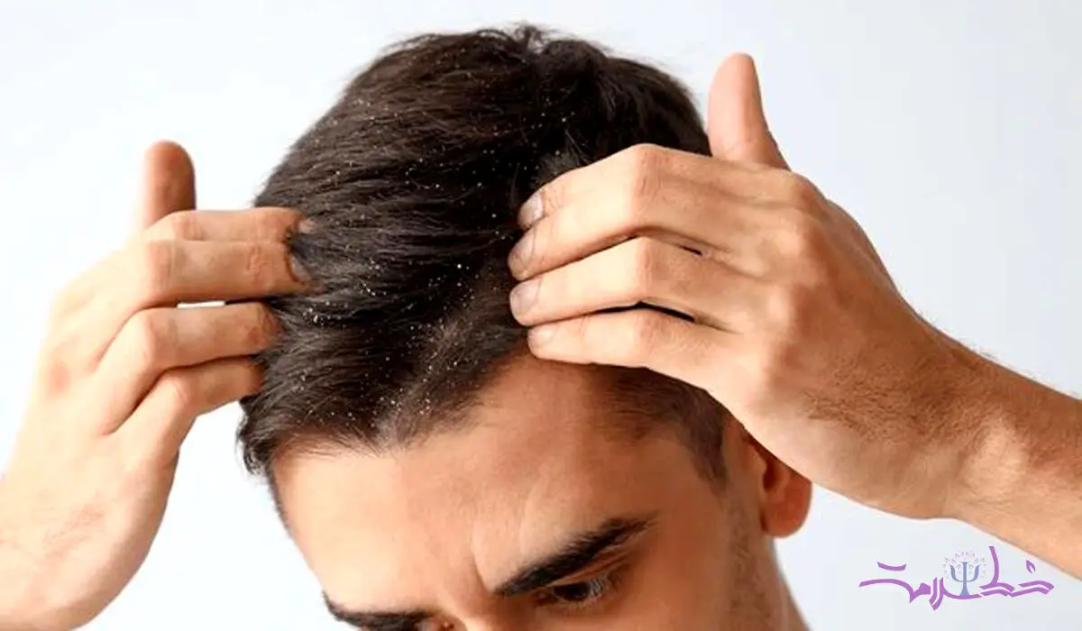 فیلم/ علل ایجاد شوره سر و آخرین شیوه درمان + چرا بعضی افراد شوره می گیرند؟