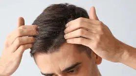 فیلم/ علل ایجاد شوره سر و آخرین شیوه درمان + چرا بعضی افراد شوره می گیرند؟