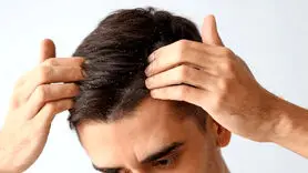فیلم/ علل ایجاد شوره سر و آخرین شیوه درمان + چرا بعضی افراد شوره می گیرند؟