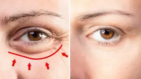 تورم و پف چه دلایلی دارد؟ 