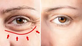 تورم و پف چه دلایلی دارد؟ 