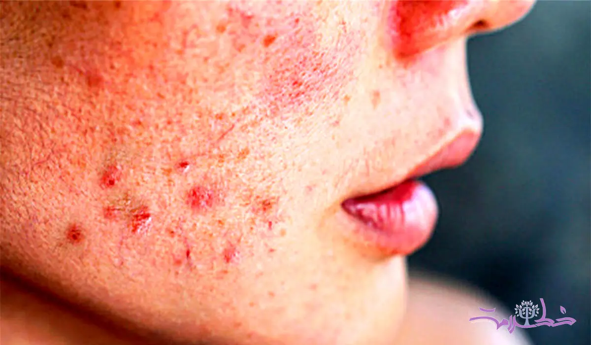 9 درمان طبیعی برای از بین بردن لک پوست 