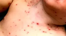 آیا شما هم به آبله مرغان مبتلا می‌شوید؟ کشف دلایلی که همه را درگیر می‌کند!