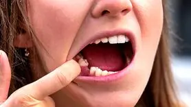 روانشناسی تعبیر خواب / 12 تعبیر خواب در مورد افتادن دندان و رویاهای تکرار شونده
