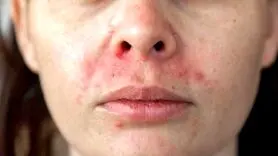 علل و علائم ابتلا به اگزما 
