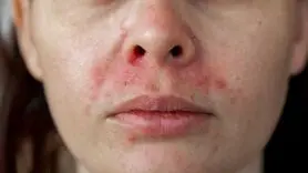 علل و علائم ابتلا به اگزما 