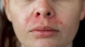 علل و علائم ابتلا به اگزما 