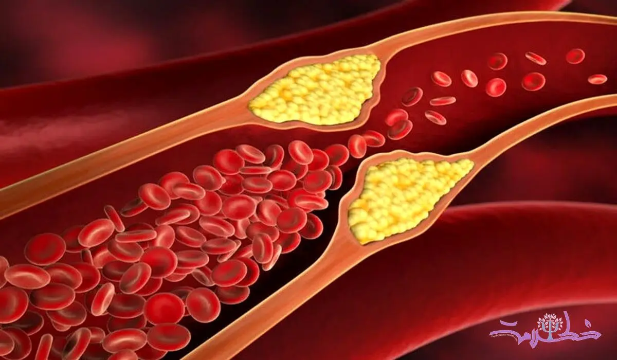 رایج ترین علائم چربی خون بالا + روش های درمان