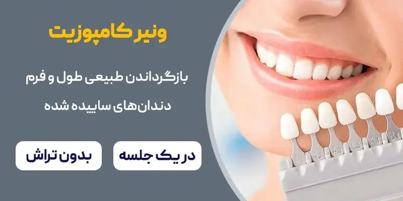 ترمیم ساییدگی دندان جلو با ونیر کامپوزیت