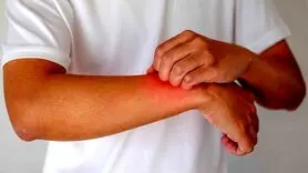 با این 7 شیوه طبیعی درد و خارش اگزما را کاهش دهید