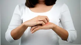 آیا استرس باعث کهیر می شود؟