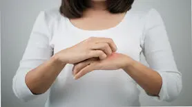 آیا استرس باعث کهیر می شود؟
