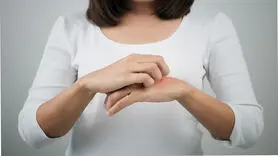 آیا استرس باعث کهیر می شود؟