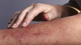دلیل دانه های قرمز بدون خارش روی پوست