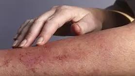 دلیل دانه های قرمز بدون خارش روی پوست