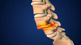 علل و پیشگیری از شکستگی های فشاری ستون فقرات