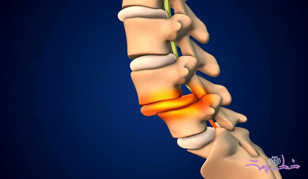 علل و پیشگیری از شکستگی های فشاری ستون فقرات