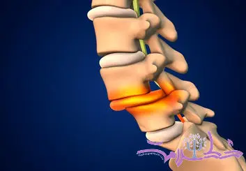 علل و پیشگیری از شکستگی های فشاری ستون فقرات