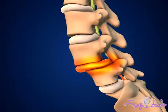 علل و پیشگیری از شکستگی های فشاری ستون فقرات