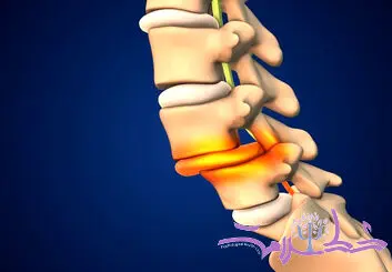علل و پیشگیری از شکستگی های فشاری ستون فقرات