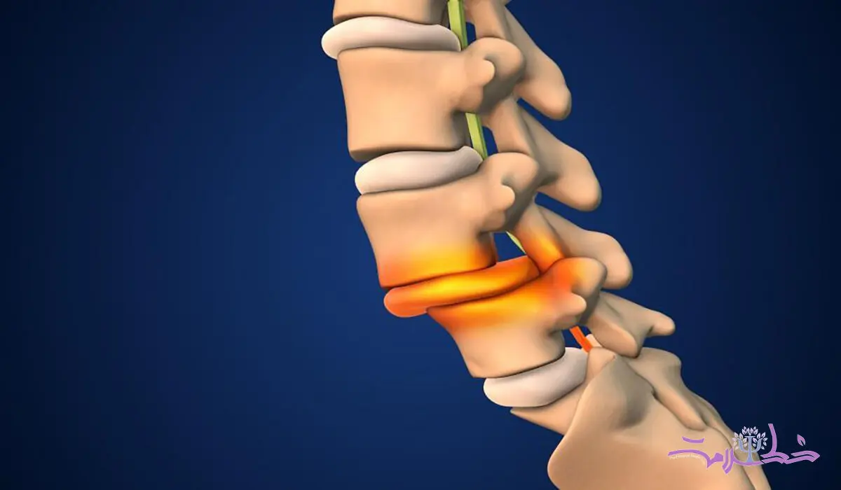 علل و پیشگیری از شکستگی های فشاری ستون فقرات