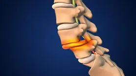 علل و پیشگیری از شکستگی های فشاری ستون فقرات
