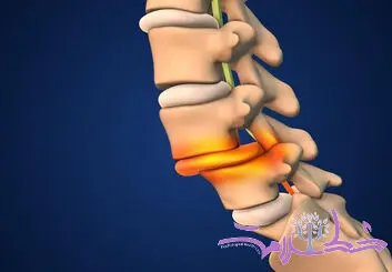 علل و پیشگیری از شکستگی های فشاری ستون فقرات