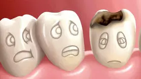 درمان و پیشگیری از پوسیدگی دندان