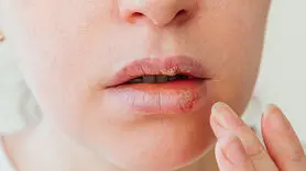 چرا دائما تبخال می‌زنید؟