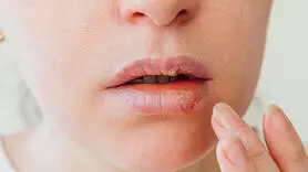 چرا دائما تبخال می‌زنید؟