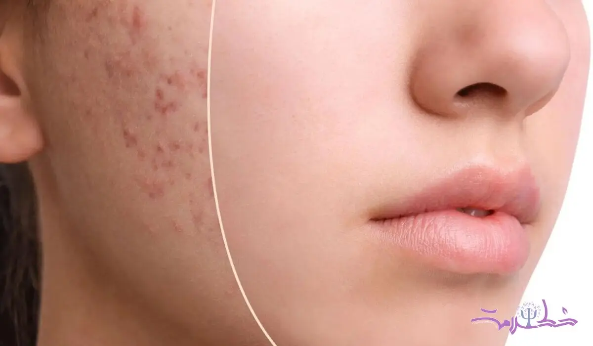 چه کسانی نباید قرص راکوتان بخورند؟ 