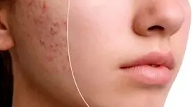 چه کسانی نباید قرص راکوتان بخورند؟ 