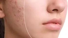 چه کسانی نباید قرص راکوتان بخورند؟ 