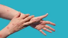 آیا احتمال ابتلا و شیوع آبله میمونی در ایران وجود دارد؟