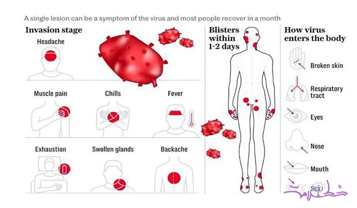 خلاصه و کامل درباره ویروس Mpox یا آبله میمون بدانید