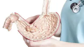 ۷ مشکل گوارشی که عامل افزایش وزن است