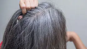 سفید شدن موها زیر سر کمبود 9 ویتامین است