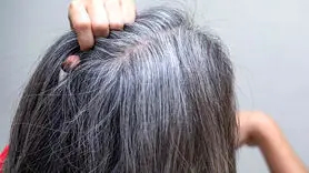 سفید شدن موها زیر سر کمبود 9 ویتامین است