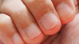 علت ناخن جویدن کودکان و راه حل رفع ترک این عادت نامناسب