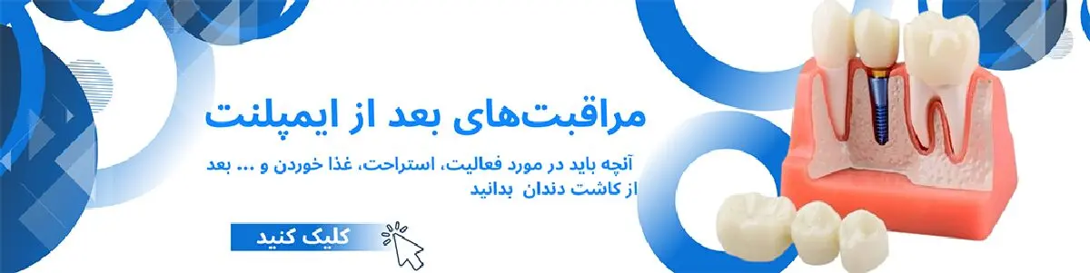 مراقبت‌های بعد از ایمپلنت و کاشت دندان با کمپرس سرد و گرم