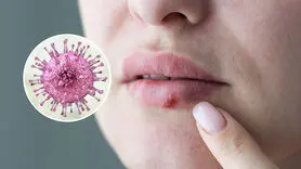 آیا تبخال فقط از طریق بوسه منتقل می‌شود؟ حقیقتی که بسیاری نمی‌دانند/  تبخال (هرپس) چیست؟ آیا ویروس HSV تا آخر عمر در بدن می‌ماند؟ علائم، راه‌های انتقال و درمان
