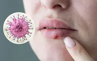 آیا تبخال فقط از طریق بوسه منتقل می‌شود؟ حقیقتی که بسیاری نمی‌دانند/  تبخال (هرپس) چیست؟ آیا ویروس HSV تا آخر عمر در بدن می‌ماند؟ علائم، راه‌های انتقال و درمان
