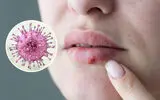 آیا تبخال فقط از طریق بوسه منتقل می‌شود؟ حقیقتی که بسیاری نمی‌دانند/  تبخال (هرپس) چیست؟ آیا ویروس HSV تا آخر عمر در بدن می‌ماند؟ علائم، راه‌های انتقال و درمان
