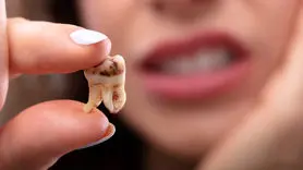 ببینید پوسیدگی دندان های تان چگونه بوجود می آید + ویدئو