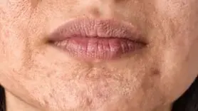 چه کنید در هوای گرما جوش نزنید ؟ + 16 روش 